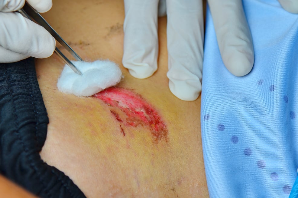 Dressing abrasion wound.